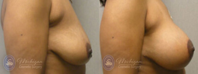 Breast Augmentation with Medium Lift Before and After Photo by Dr. Awada in Southfield Michigan