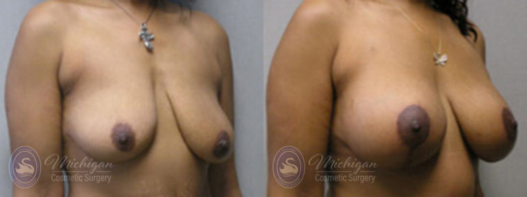 Breast Augmentation with Medium Lift Before and After Photo by Dr. Awada in Southfield Michigan