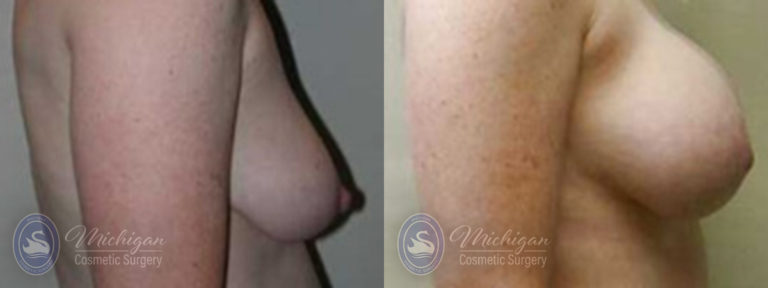 Breast Augmentation with Medium Lift Before and After Photo by Dr. Awada in Southfield Michigan