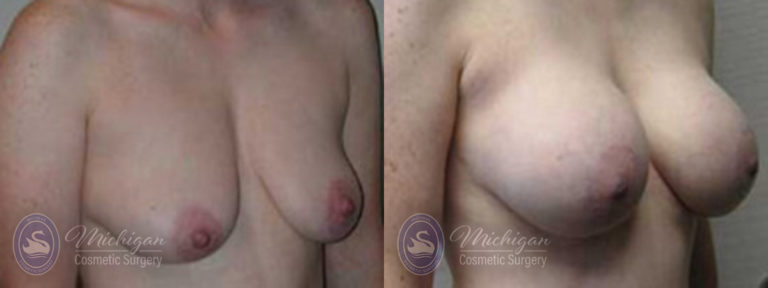 Breast Augmentation with Medium Lift Before and After Photo by Dr. Awada in Southfield Michigan