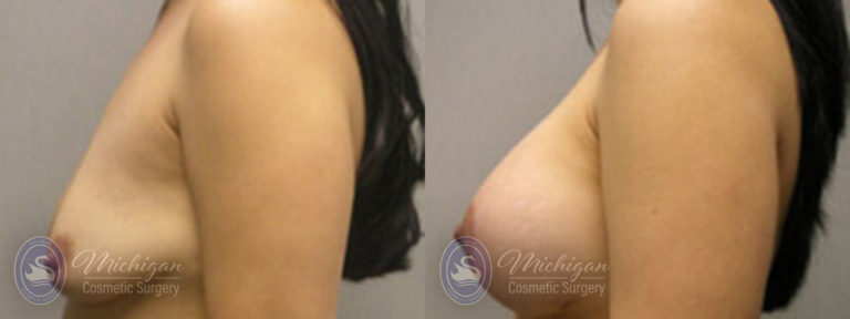 Breast Augmentation with Medium Lift Before and After Photo by Dr. Awada in Southfield Michigan