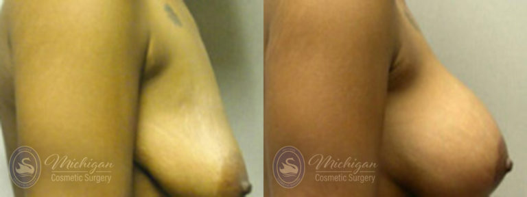 Breast Augmentation with Medium Lift Before and After Photo by Dr. Awada in Southfield Michigan