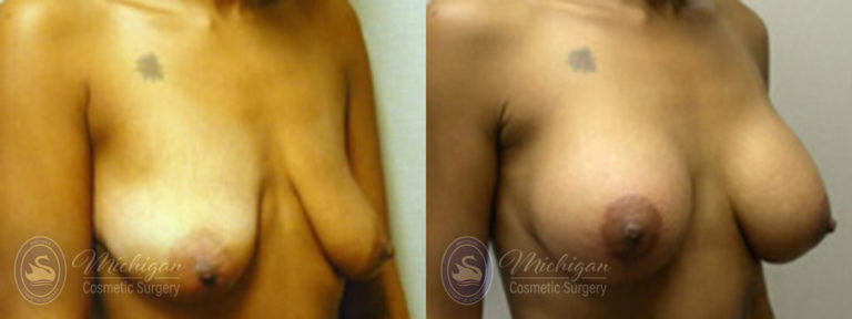 Breast Augmentation with Medium Lift Before and After Photo by Dr. Awada in Southfield Michigan