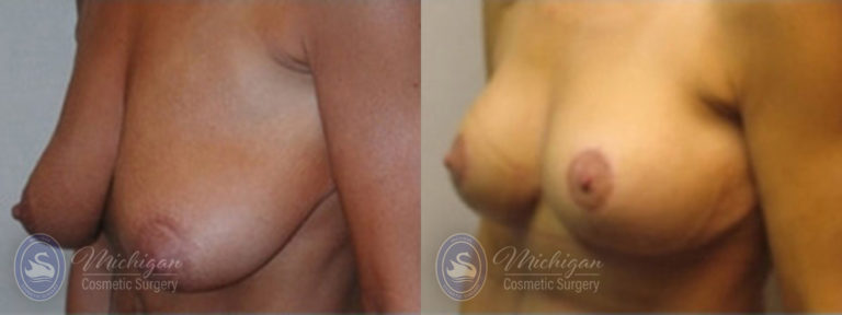 Breast Augmentation with Medium Lift Before and After Photo by Dr. Awada in Southfield Michigan