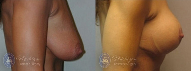 Breast Augmentation with Medium Lift Before and After Photo by Dr. Awada in Southfield Michigan