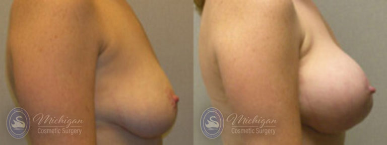 Breast Augmentation with Medium Lift Before and After Photo by Dr. Awada in Southfield Michigan