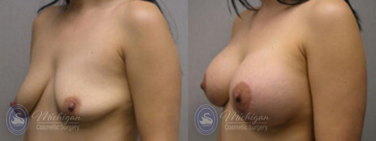 Breast Augmentation with Medium Lift Before and After Photo by Dr. Awada in Southfield Michigan
