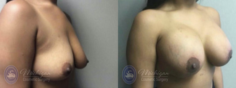Breast Augmentation with Medium Lift Before and After Photo by Dr. Awada in Southfield Michigan