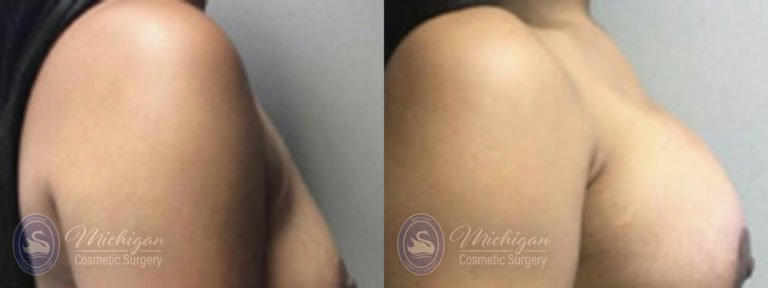 Breast Augmentation with Medium Lift Before and After Photo by Dr. Awada in Southfield Michigan