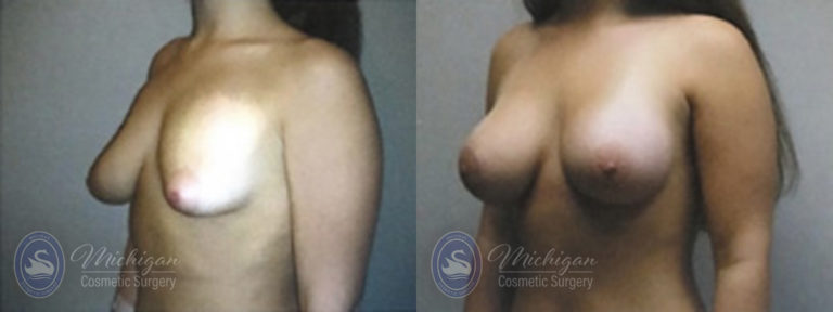 Breast Augmentation with Medium Lift Before and After Photo by Dr. Awada in Southfield Michigan