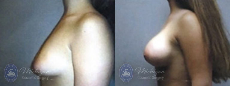 Breast Augmentation with Medium Lift Before and After Photo by Dr. Awada in Southfield Michigan
