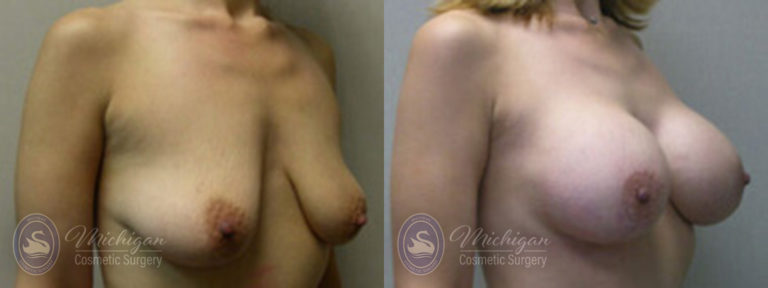 Breast Augmentation with Medium Lift Before and After Photo by Dr. Awada in Southfield Michigan