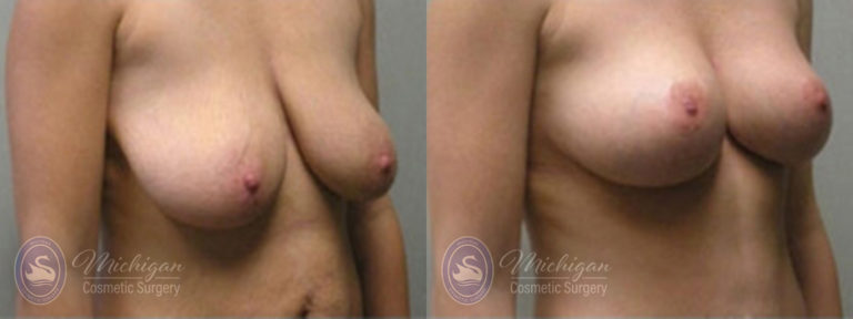 Breast Augmentation with Medium Lift Before and After Photo by Dr. Awada in Southfield Michigan
