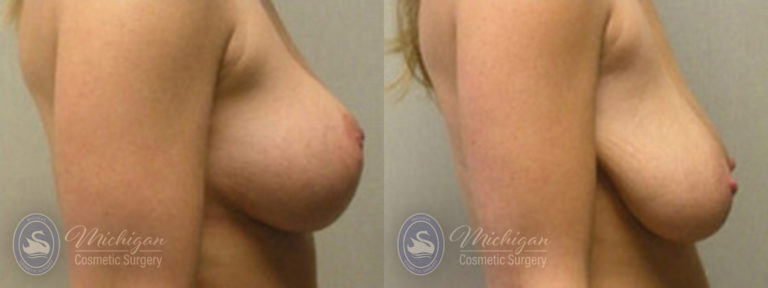 Breast Augmentation with Medium Lift Before and After Photo by Dr. Awada in Southfield Michigan
