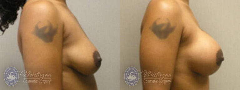 Breast Augmentation with Medium Lift Before and After Photo by Dr. Awada in Southfield Michigan