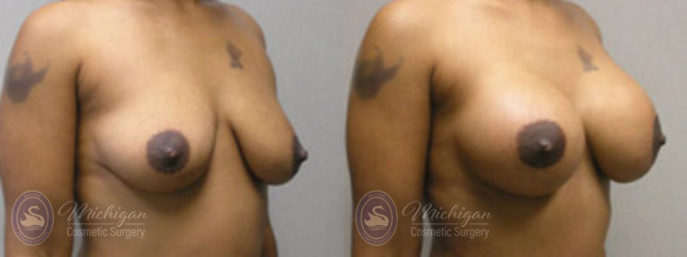 Breast Augmentation with Medium Lift Before and After Photo by Dr. Awada in Southfield Michigan