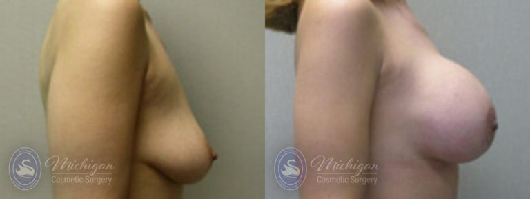 Breast Augmentation with Medium Lift Before and After Photo by Dr. Awada in Southfield Michigan
