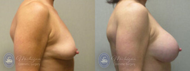 Breast Augmentation with Medium Lift Before and After Photo by Dr. Awada in Southfield Michigan