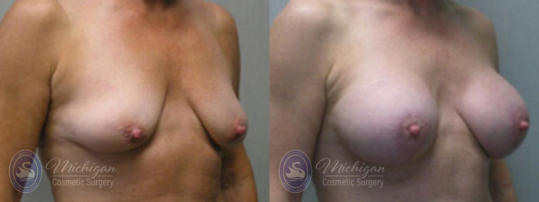 Breast Augmentation with Medium Lift Before and After Photo by Dr. Awada in Southfield Michigan