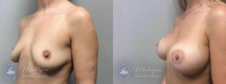 Breast Augmentation with Medium Lift Before and After Photo by Dr. Awada in Southfield Michigan