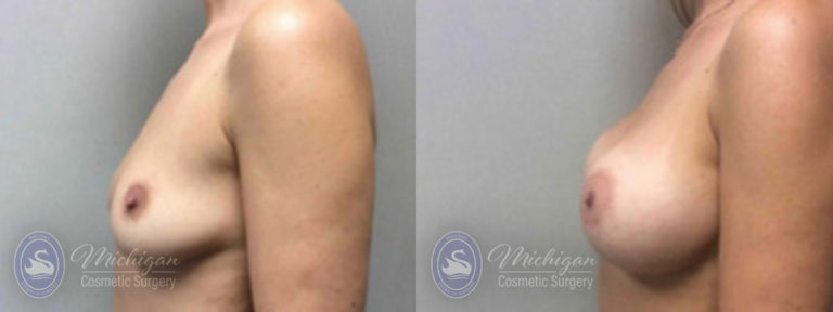 Breast Augmentation with Medium Lift Before and After Photo by Dr. Awada in Southfield Michigan