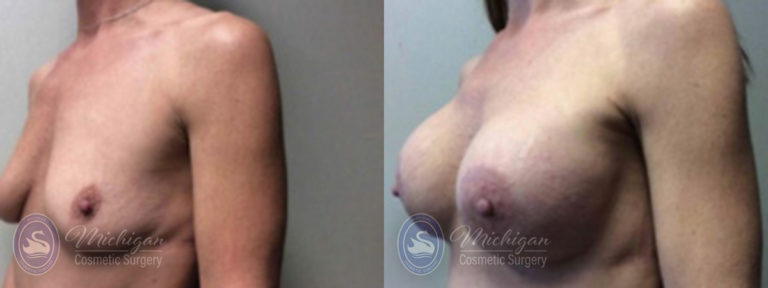 Breast Augmentation with Medium Lift Before and After Photo by Dr. Awada in Southfield Michigan