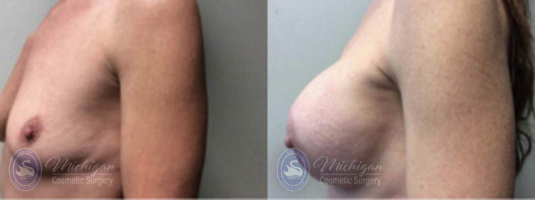 Breast Augmentation with Medium Lift Before and After Photo by Dr. Awada in Southfield Michigan