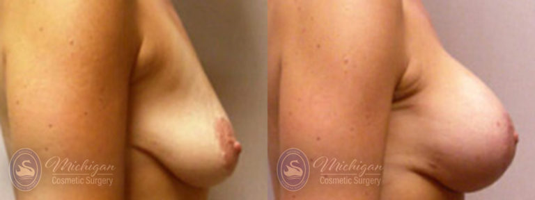 Breast Augmentation with Medium Lift Before and After Photo by Dr. Awada in Southfield Michigan