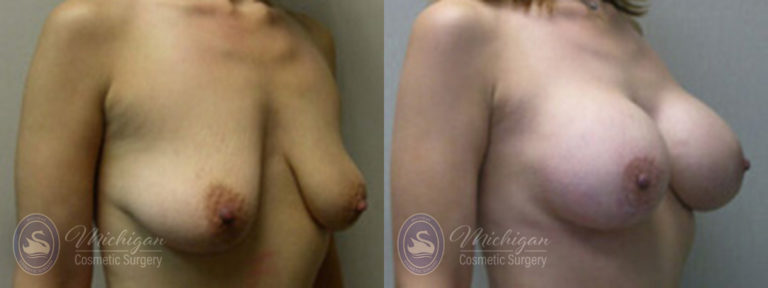 Breast Augmentation with Medium Lift Before and After Photo by Dr. Awada in Southfield Michigan