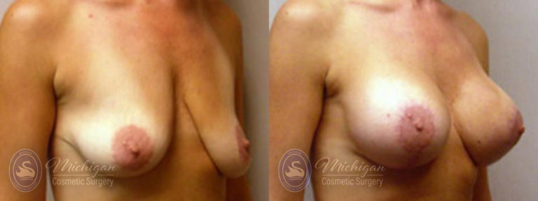 Breast Augmentation with Medium Lift Before and After Photo by Dr. Awada in Southfield Michigan