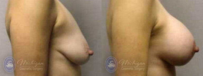 Breast Augmentation with Medium Lift Before and After Photo by Dr. Awada in Southfield Michigan