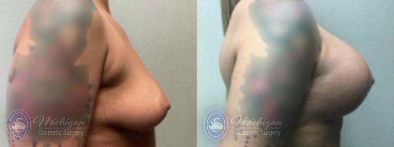 Breast Asymmetry Before and After Photo by Dr. Awada in Southfield Michigan