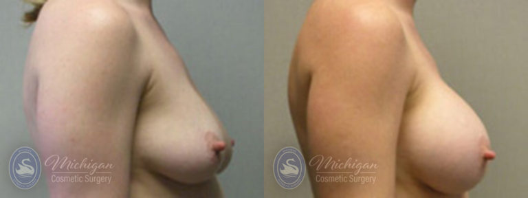 Breast Augmentation with Small Lift Before and After Photo by Dr. Awada in Southfield Michigan