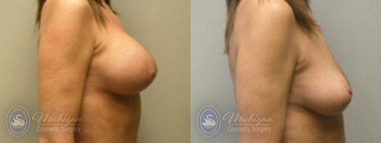 Breast Augmentation with Small Lift Before and After Photo by Dr. Awada in Southfield Michigan