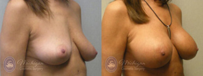 Breast Augmentation with Small Lift Before and After Photo by Dr. Awada in Southfield Michigan