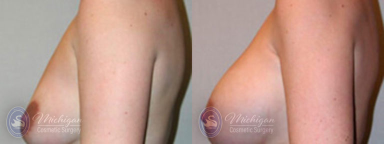 Breast Augmentation with Small Lift Before and After Photo by Dr. Awada in Southfield Michigan