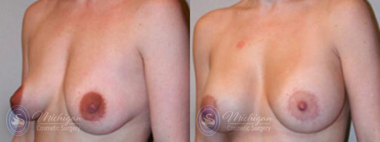 Breast Augmentation with Small Lift Before and After Photo by Dr. Awada in Southfield Michigan
