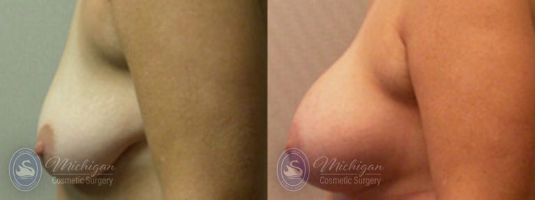 Breast Augmentation with Small Lift Before and After Photo by Dr. Awada in Southfield Michigan