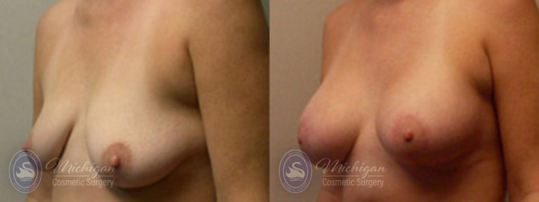 Breast Augmentation with Small Lift Before and After Photo by Dr. Awada in Southfield Michigan