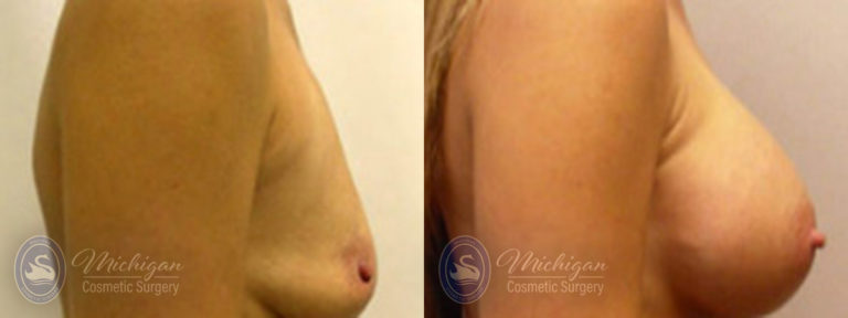 Breast Augmentation with Small Lift Before and After Photo by Dr. Awada in Southfield Michigan