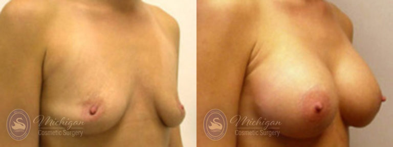 Breast Augmentation with Small Lift Before and After Photo by Dr. Awada in Southfield Michigan