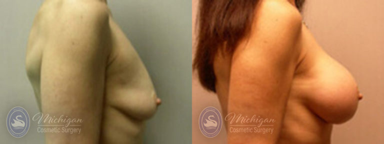 Breast Augmentation with Small Lift Before and After Photo by Dr. Awada in Southfield Michigan