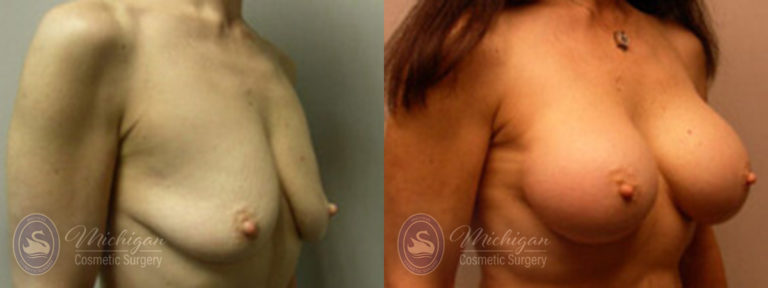 Breast Augmentation with Small Lift Before and After Photo by Dr. Awada in Southfield Michigan