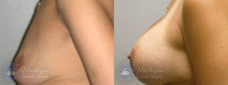 Breast Augmentation with Small Lift Before and After Photo by Dr. Awada in Southfield Michigan