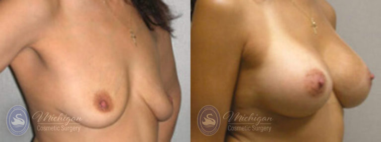 Breast Augmentation with Small Lift Before and After Photo by Dr. Awada in Southfield Michigan