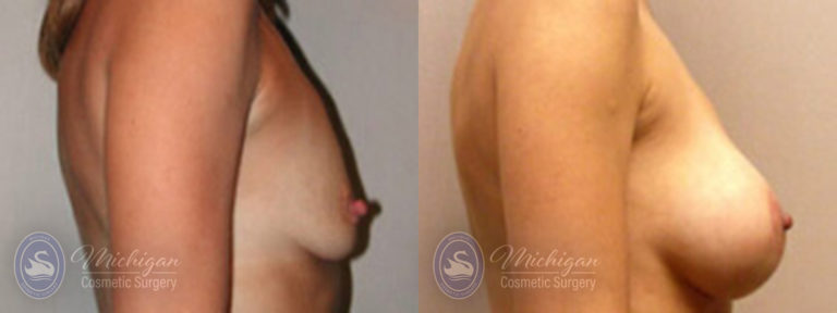 Breast Augmentation with Small Lift Before and After Photo by Dr. Awada in Southfield Michigan