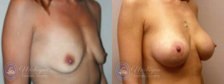 Breast Augmentation with Small Lift Before and After Photo by Dr. Awada in Southfield Michigan