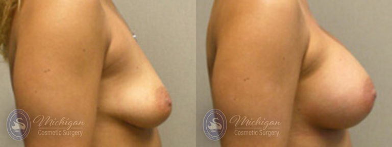 Breast Augmentation with Small Lift Before and After Photo by Dr. Awada in Southfield Michigan