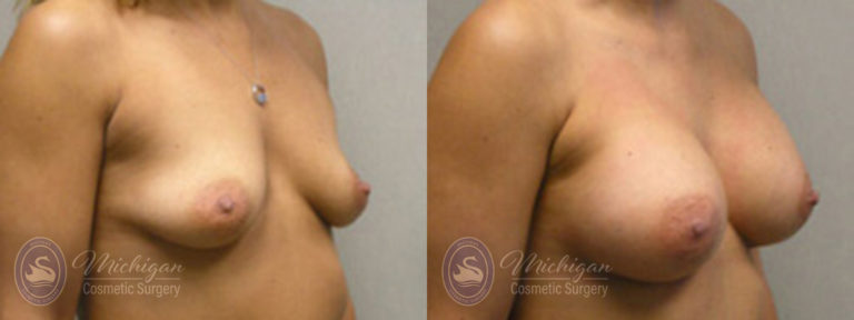 Breast Augmentation with Small Lift Before and After Photo by Dr. Awada in Southfield Michigan