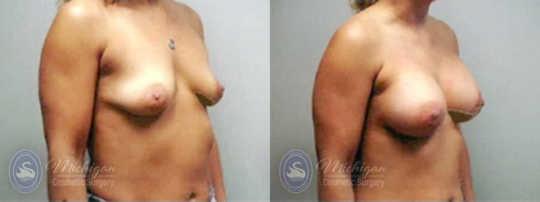 Breast Augmentation with Small Lift Before and After Photo by Dr. Awada in Southfield Michigan